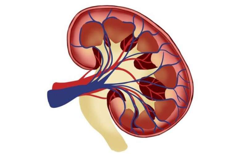 چگونه خطر سنگ کلیه را کاهش دهیم؟