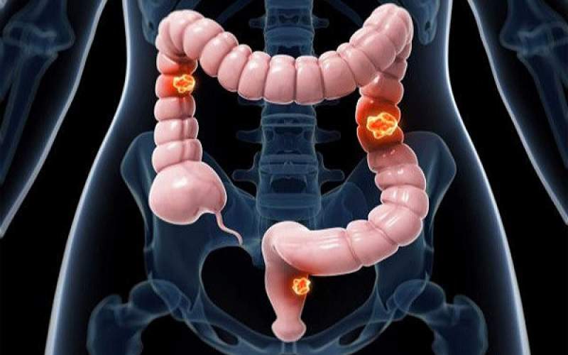 بهترین داروی گیاهی برای جلوگیری از سرطان روده
