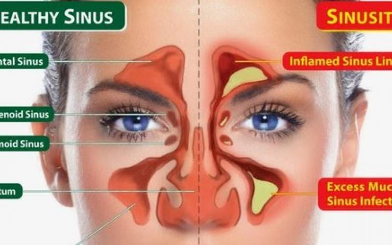 راهکارهایی برای درمان «سینوزیت»
