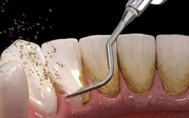 آیا جرم گیری دندان ضرر دارد؟