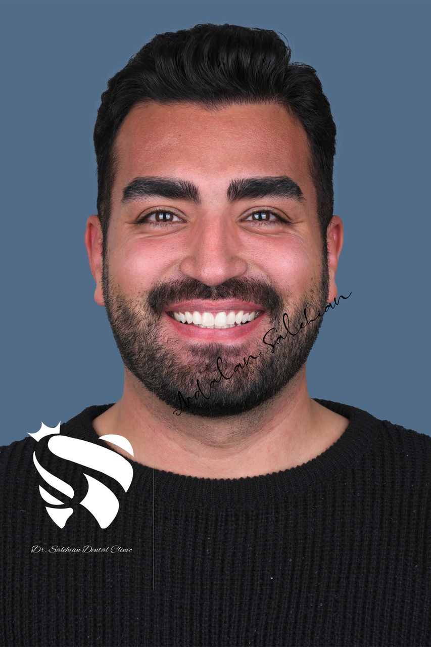 نمونه کار بلیچینگ دندان در کلینیک دکتر صالحیان