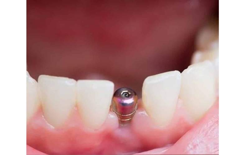 آیا ایمپلنت درد دارد؟