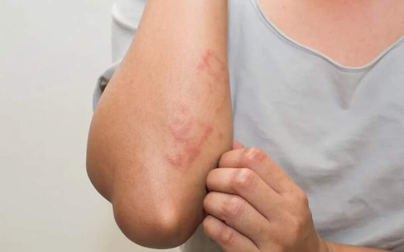 بیماری «سلیاک» چیست و چه علائمی دارد؟