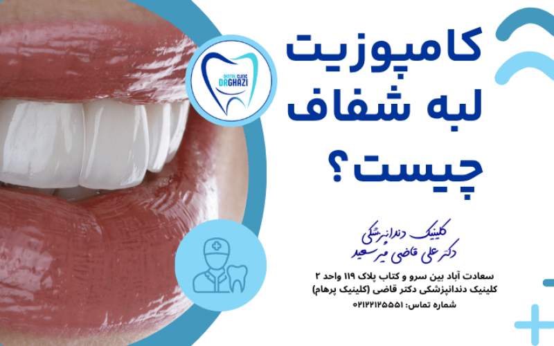 مزایای کامپوزیت لبه شفاف