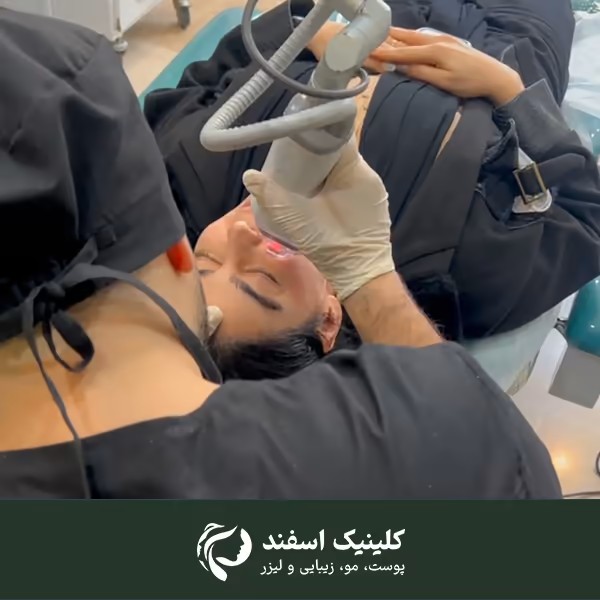 قیمت لیزر جای جوش