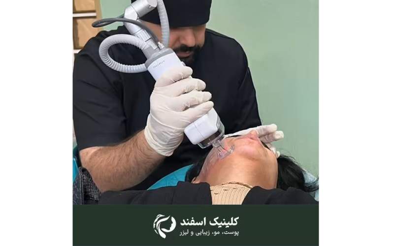 هزینه لیزر جای جوش