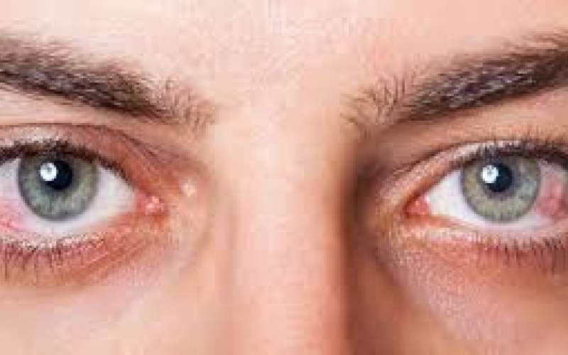 آب مروارید؛ علل، علائم و راهکارهای درمانی