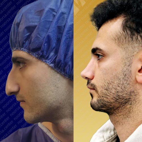 قبل و بعد از عمل بینی
