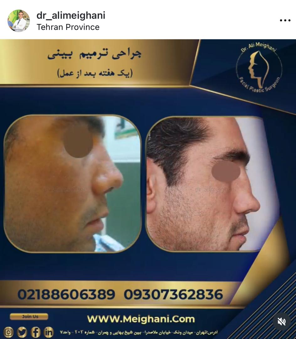 مراحل عمل ترمیمی بینی در تهران
