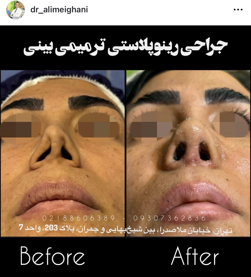 هزینه عمل ترمیمی بینی در تهران