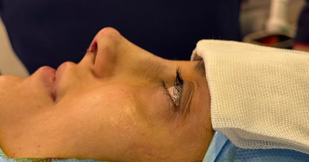 جراحی بینی با بی حسی