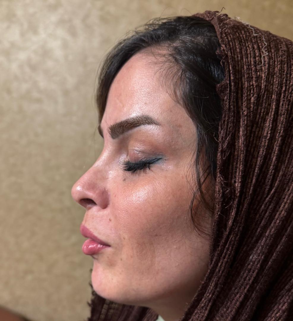 عمل رینوپلاستی