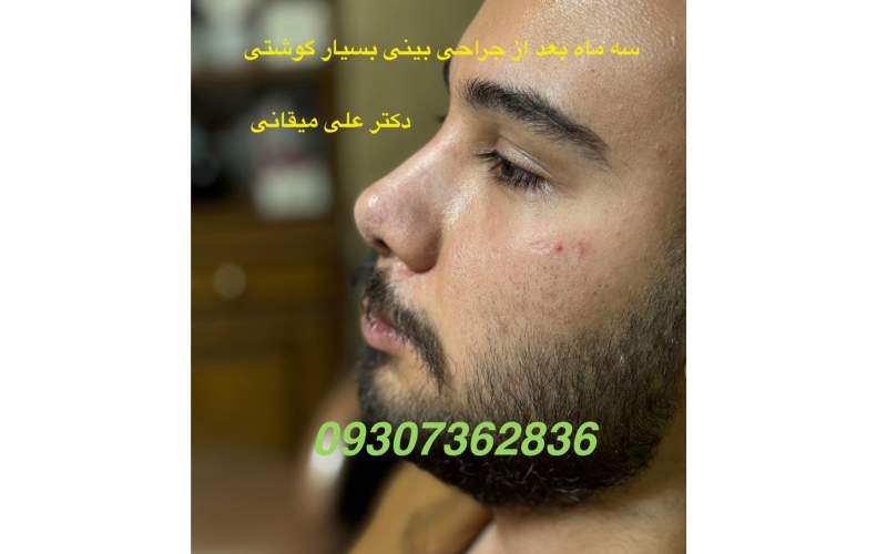 جراحی بینی بدون بیهوشی
