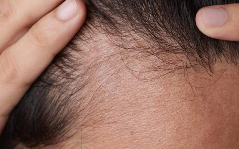 عادت‌های ساده برای جلوگیری از ریزش مو