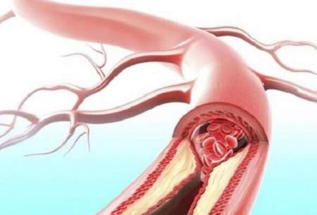 رابطه سن و جنس با «رسوب کلسیم» در شریان کاروتید قلبی