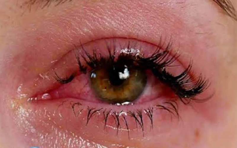 خطرات پنهان اکستنشن مژه برای سلامت چشم